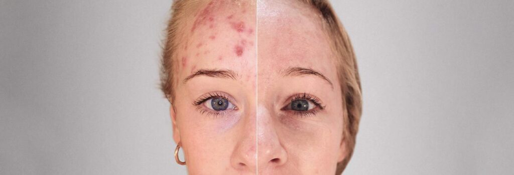 Cura Acne e rosacea | Dermatolo Roma