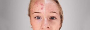 Cura Acne e rosacea | Dermatolo Roma