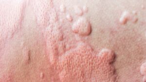 Orticaria | Dermatologo Roma
