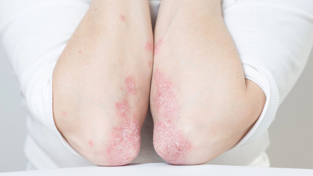 Psoriasi
